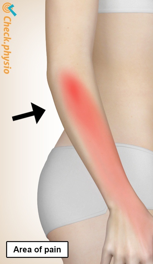 arm Radiales Tunnelsyndrom Position