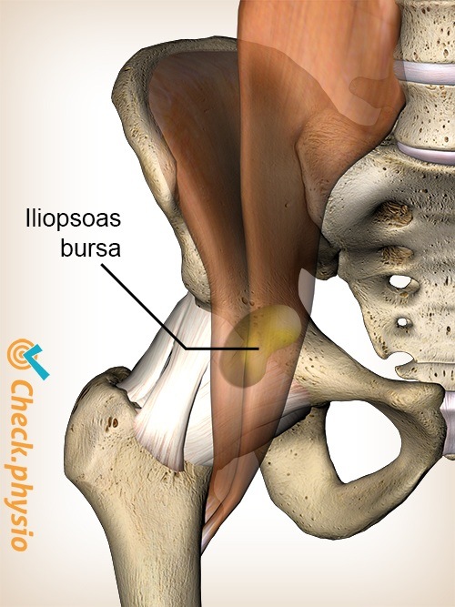 Hüfte Iliopsoas Bursa Bursitis