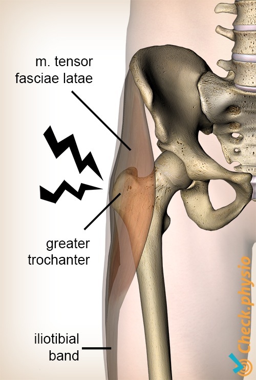 Hüfte Trochanter Major Schmerzsyndrom Anatomie Tensor Fasciae Latae Tractus Iliotibialis