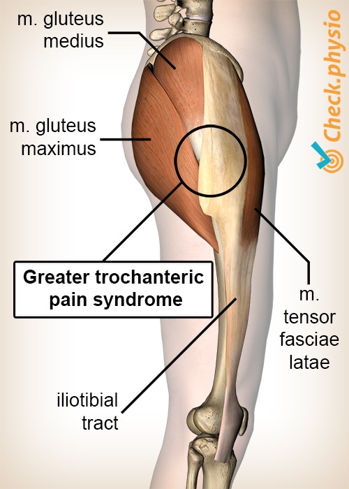 Hüfte Trochanter Major Schmerzsyndrom Anatomie