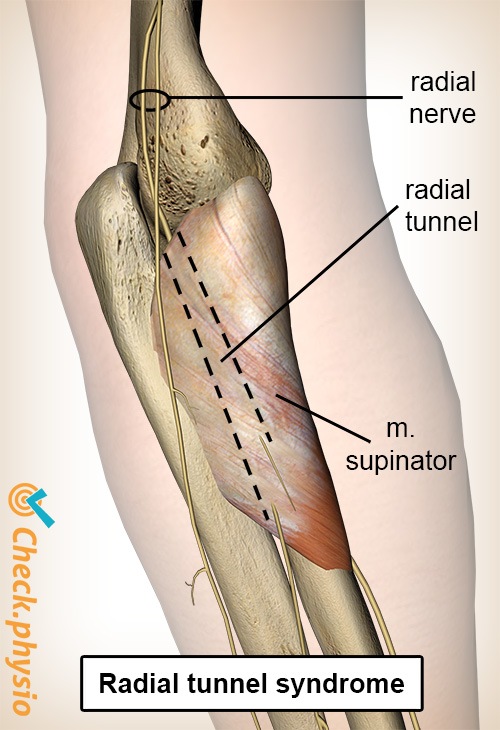 arm Radialer Tunnel Nervus radialis