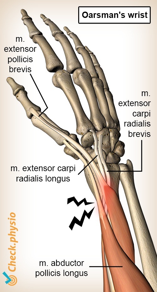 Arm Rower's Wrist Anatomie Extensor carpi radialis brevis longus Abductor pollicis