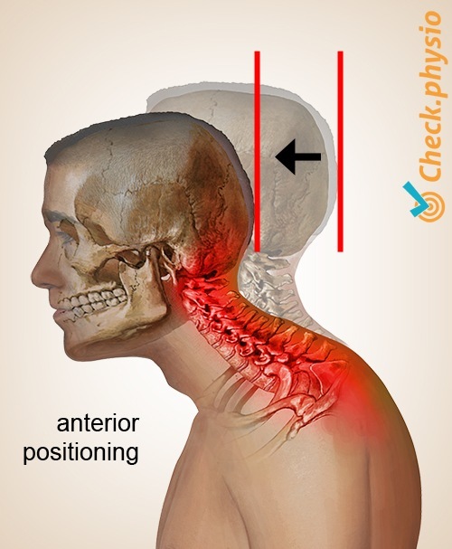 Kopf Hals Zervikales Haltungssyndrom Anteroposition