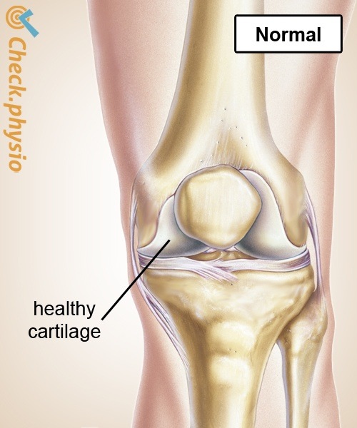 Knie Arthrose gesunder Knorpel