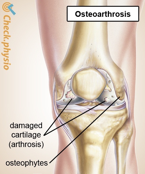 Knie Arthrose Knorpelabnutzung