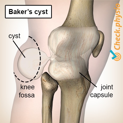 Knie Baker-Zyste Poplitealzyste