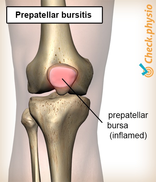 Knie Bursitis präpatellaris Bursa entzündeter Schleimbeutel Kniescheibe