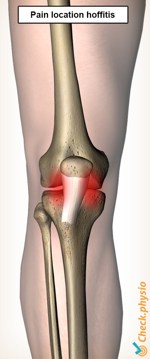 Knie Hoffitis Schmerzlokalisation