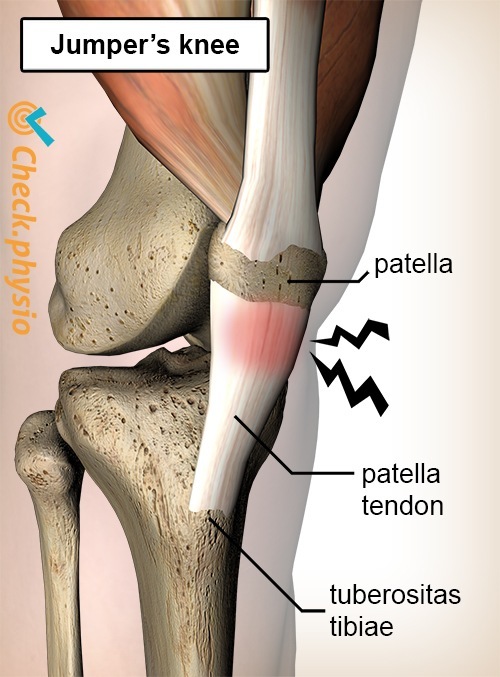 Knie Jumpers Knee Schmerz Patella Sehne Tendinitis