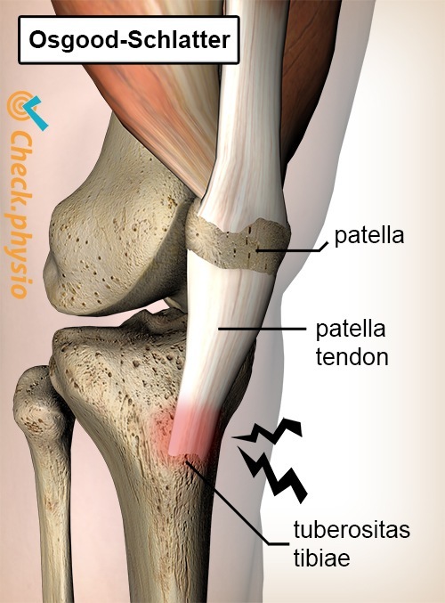 Knie Osgood Schlatter Schmerz Patella Sehne