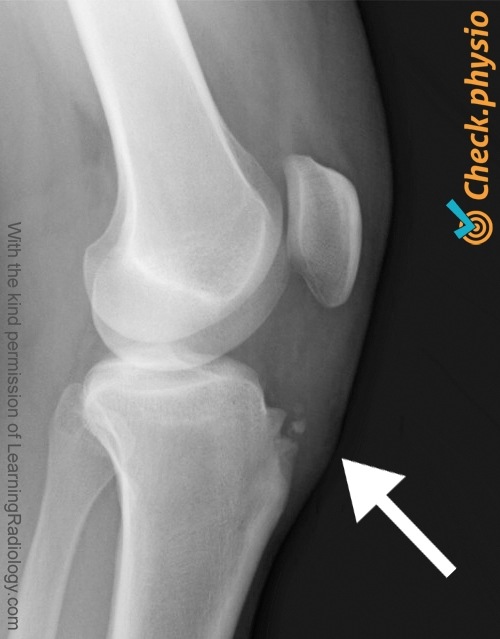 Knie Osgood Schlatter Röntgen