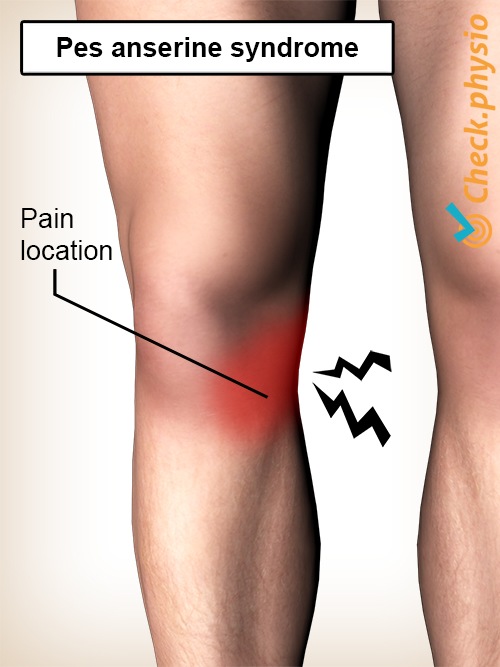 Knie Pes-Anserinus-Syndrom Schmerzlokalisation