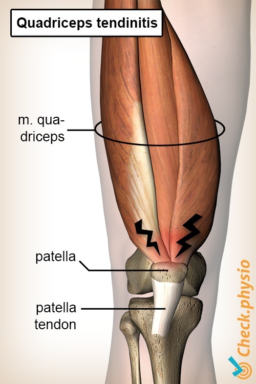 Knie Quadrizeps Tendinitis Anatomie