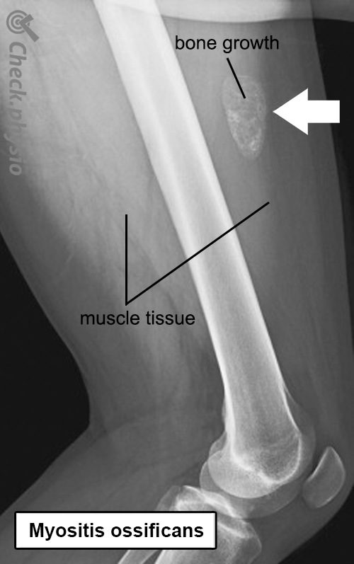 myositis ossificans Röntgenaufnahme Anatomie