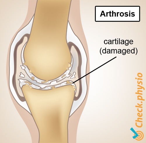 Arthrose Anatomie Abnutzung