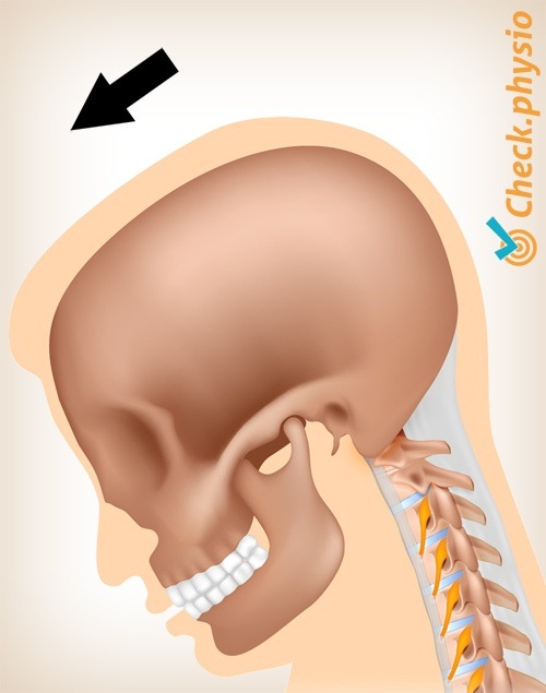 Nacken Whiplash Schmerz Bewegung 2