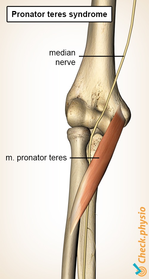 Unterarm Pronator-Teres Muskel Medianus Nerv Syndrom