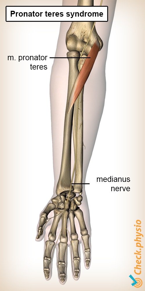 Unterarm Pronator-Teres-Syndrom Muskel Nervus medianus Nerv