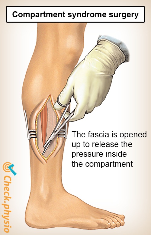 Unterschenkel Kompartmentsyndrom Operation