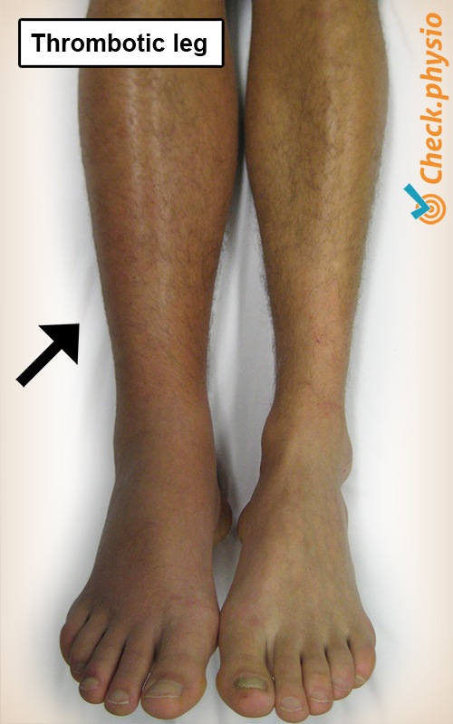 Unterschenkel thrombotisches Bein Thrombose Schwellung