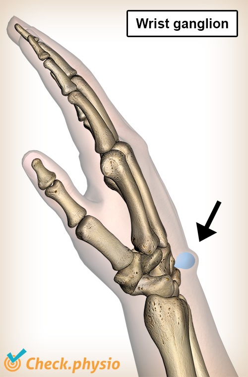 Handgelenk Ganglion Schwellung Anatomie Schleimzyste