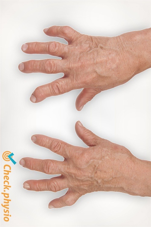 Rheumatoide Arthritis Finger