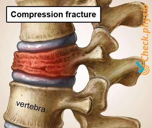 rückspezifische untere Rückenschmerzen zusammengebrochener Wirbel
