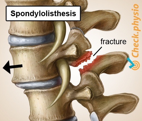 rückspezifische untere Rückenschmerzen Spondylolisthesis verschobener Wirbel