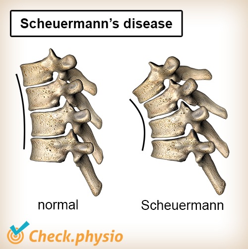 Rücken Scheuermann-Krankheit Wirbelsäule normal Krümmung Kyphose Anatomie keilförmig