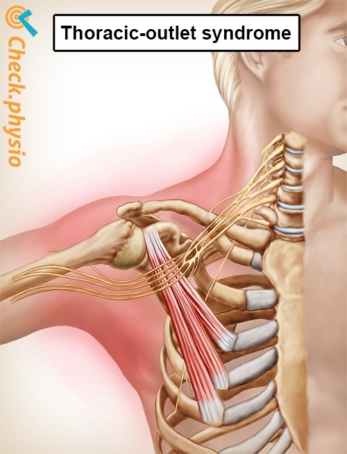 Schulter Arm Hand Thoracic-outlet-Syndrom Anatomie