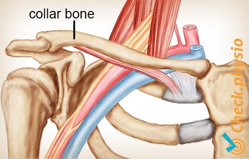 Schulter Arm Hand TOS Thoracic-outlet-Syndrom Schlüsselbein