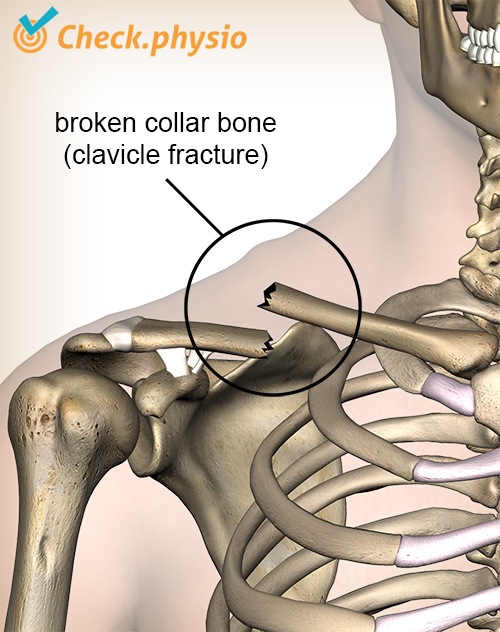 Schulter Klavikulafraktur gebrochenes Schlüsselbeinbruch