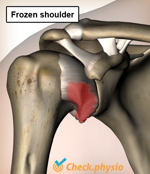 schulter frozen shoulder