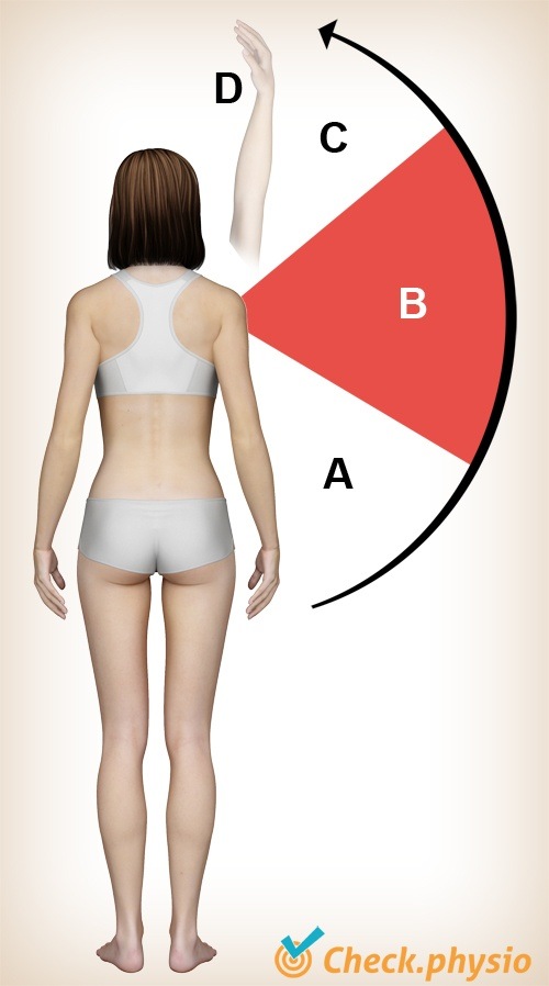 Schulterimpingement Schmerzvoller Bogen