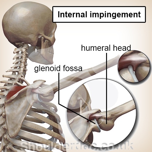 Schulter internes Impingement Schulterkopf Schulterpfanne Einklemmung