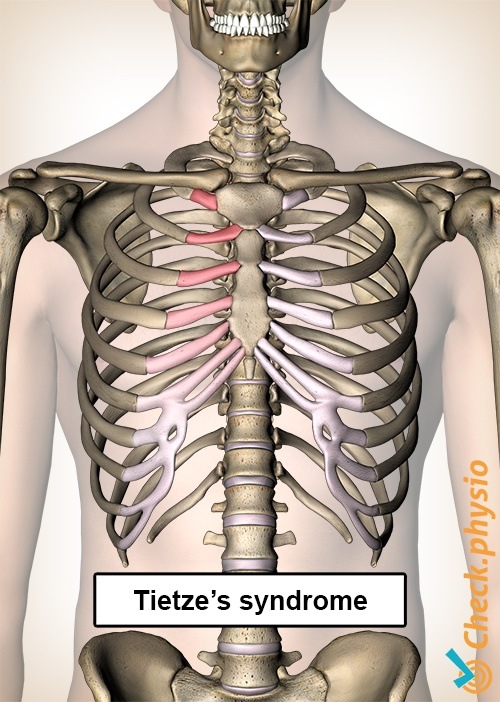 Tietze-Syndrom Rippen Schmerzen Brust Brustbein