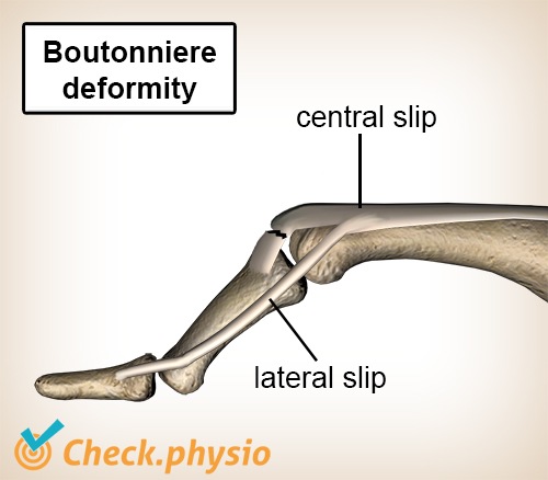 Finger Knopflochdeformität Strecksehne