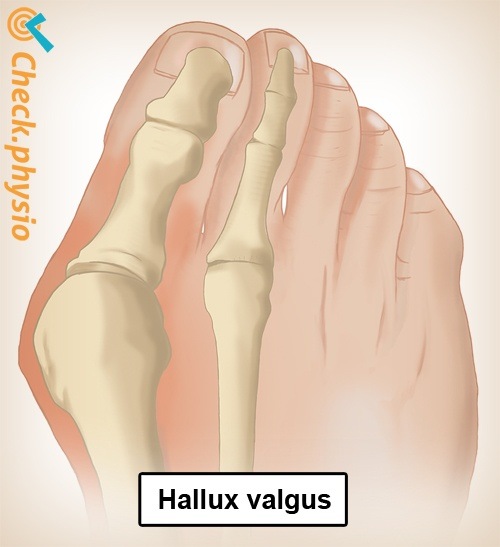 Fuß Hallux valgus Anatomie