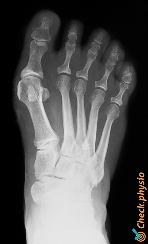 Fuß Hallux valgus Röntgenaufnahme