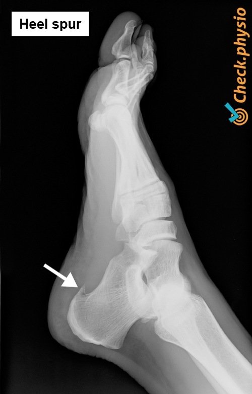 Fuß Fersensporn Röntgen