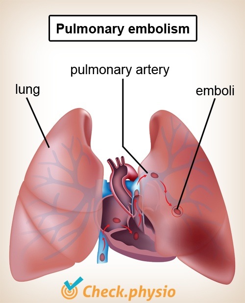 Brust Lungen Lungenembolie Herz Lungenarterie