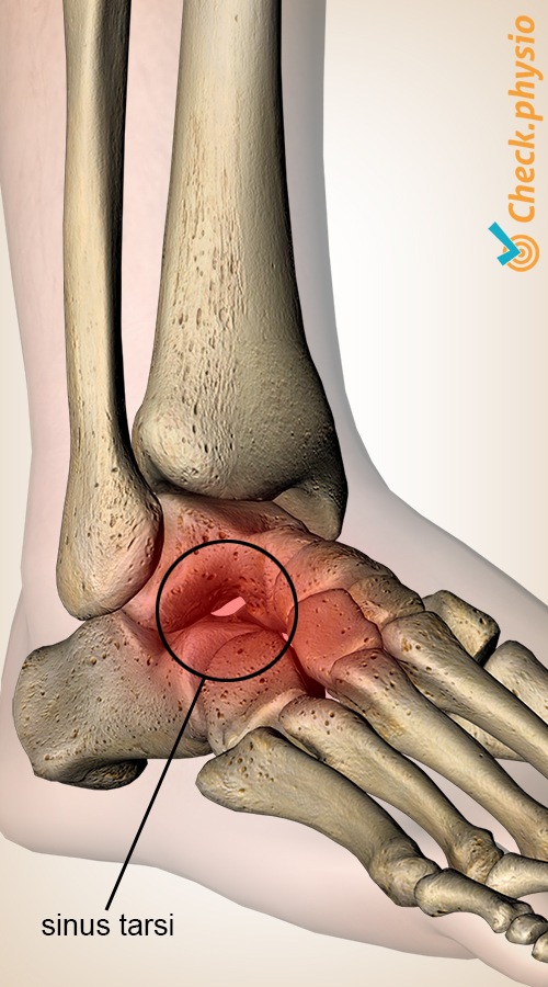 Fuß Sinus-tarsi-Syndrom Talus Kalkaneus