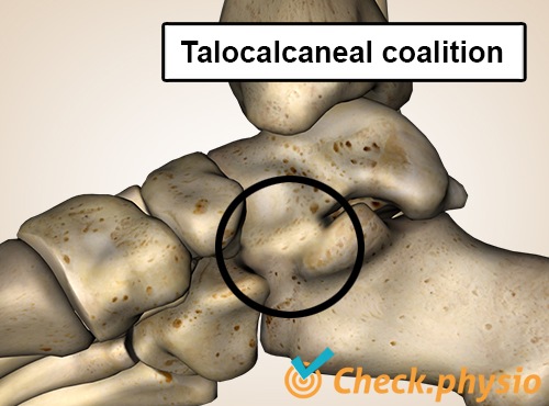 Fuß talocalcaneale Koalition