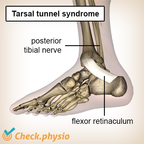 Fuß Tarsaltunnelsyndrom Nervus tibialis posterior Retinaculum flexorum