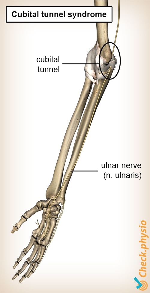 arm Cubital-Tunnel Nervus ulnaris