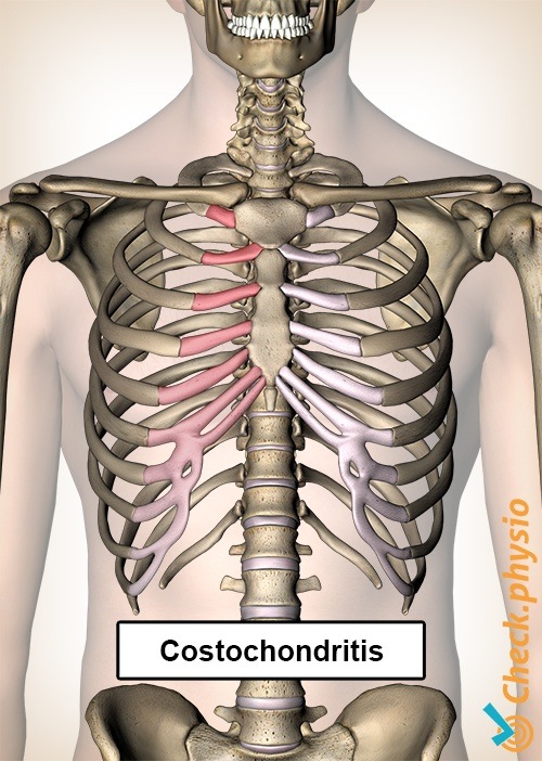 Costochondritis Rippen Schmerzen Brust Brustbein