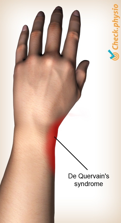 Arm De Quervain Position