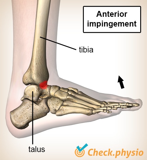 Sprunggelenk anteriore Impingement Dorsalflexion