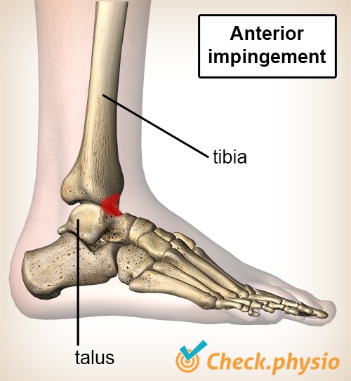 Sprunggelenk anteriore Impingement