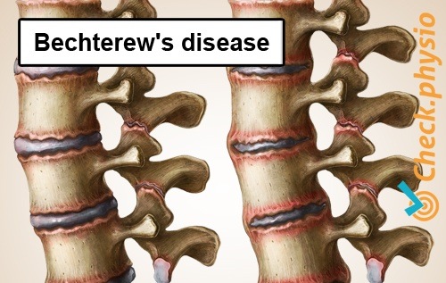 rückspezifische untere Rückenschmerzen Morbus Bechterew ankylosierende Spondylitis